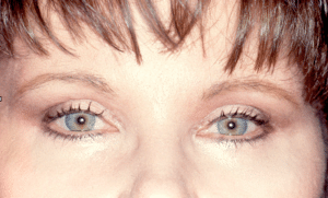 Blepharoplasty After Procedure Blepharoplasty After Procedure | Fort Myers Plastic Surgeon Dr. Patrick Flaharty