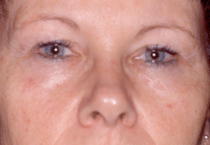 Blepharoplasty Before Procedure Blepharoplasty Before Procedure | Fort Myers Plastic Surgeon Dr. Patrick Flaharty