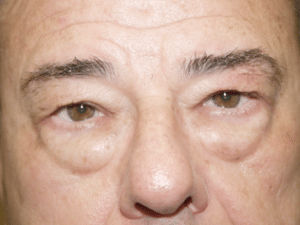 Blepharoplasty Before Procedure Blepharoplasty Before Procedure | Fort Myers Plastic Surgeon Dr. Patrick Flaharty