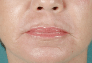 CO2 Laser Skin Resurfacing After Procedure