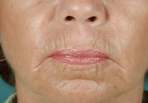 CO2 Laser Skin Resurfacing Before Procedure
