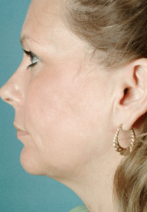 Chin Implant After Chin Implant After | Fort Myers Plastic Surgeon Dr. Patrick Flaharty