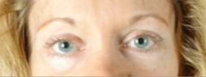 Blepharoplasty After Procedure Blepharoplasty After Procedure | Fort Myers Plastic Surgeon Dr. Patrick Flaharty