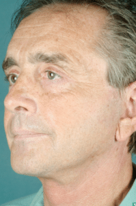 Facelift After Procedure Facelift After Procedure
