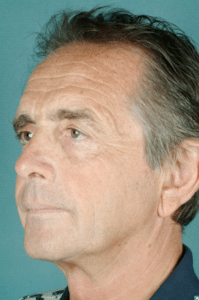 Facelift Before Procedure Facelift Before Procedure
