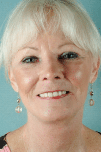 Face and Neck After Procedure Face and Neck After Procedure | Fort Myers Plastic Surgeon Dr. Patrick Flaharty