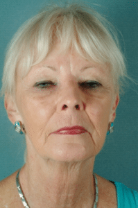 Face and Neck Before Procedure Face and Neck Before Procedure | Fort Myers Plastic Surgeon Dr. Patrick Flaharty