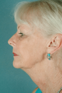 Face and Neck Before Procedure Face and Neck Before Procedure | Fort Myers Plastic Surgeon Dr. Patrick Flaharty