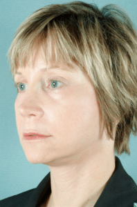 Face and Neck After Procedure Face and Neck After Procedure | Fort Myers Plastic Surgeon Dr. Patrick Flaharty