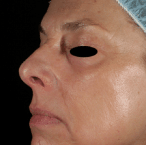 Fractional Laser After Treatment Fractional Laser After Treatment