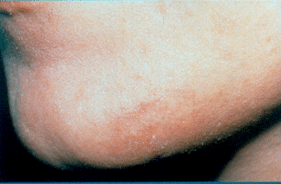 Laser Hair After Laser Hair After