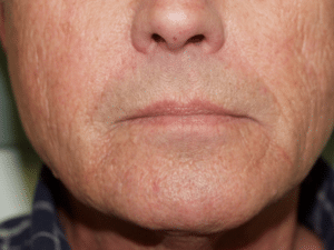 Radiesse After Treatment