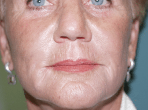 Radiesse After Treatment