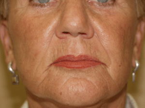 Radiesse Before Treatment