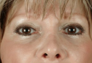 Restylane After Treatment