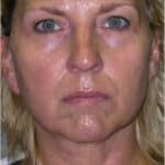 Sun Damage Laser After Sun Damage After Laser Treatment