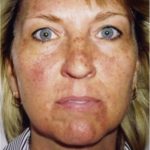 Sun Damage Laser Before Sun Damage Before Laser Treatment