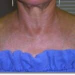 Sun damage 2 after Sun Damage After Laser Treatment