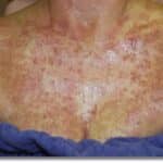 laser sun damage 2 Sun Damage Before Laser Treatment