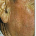 telangectasia-after Telangectasia After Laser Treatment
