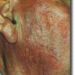 telangectasia-before Telangectasia Before Laser Treatment