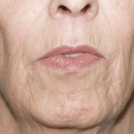 Artefill Before Procedure