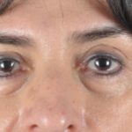 Before Procedure