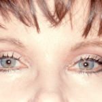 Blepharoplasty After Procedure