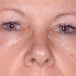 Blepharoplasty Before Procedure