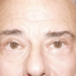 Blepharoplasty After Procedure