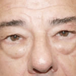 Blepharoplasty Before Procedure
