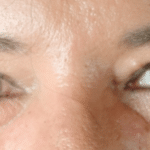 Blepharoplasty After Procedure