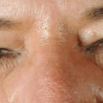 Blepharoplasty Before Procedure