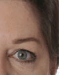Botox After Procedure