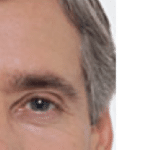 Botox After Procedure