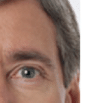 Botox Before Procedure