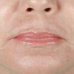 CO2 Laser After Procedure