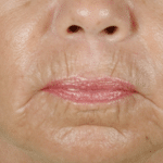 CO2 Laser Before Procedure