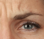 Dysport Before Procedure