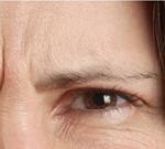 Dysport Before Procedure