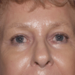 Endo Brow After Procedure