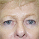Endo Brow Before Procedure
