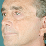 Face and Neck After Procedure