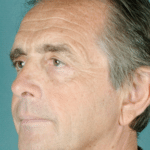 Face and Neck Before Procedure