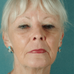 Face and Neck Before Procedure