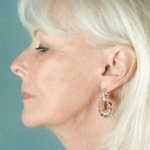 Face and Neck After Procedure