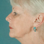 Face and Neck Before Procedure