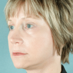 Face and Neck After Procedure