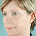 Face and Neck Before Procedure
