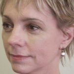 Face and Neck After Procedure